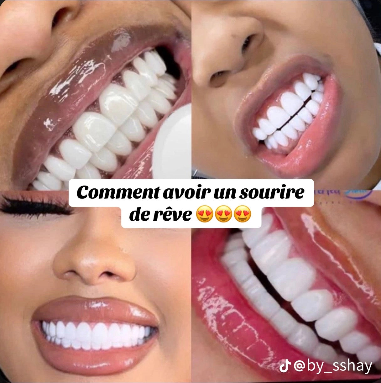 Résultat d’un blanchiment dentaire réussi – dents éclatantes